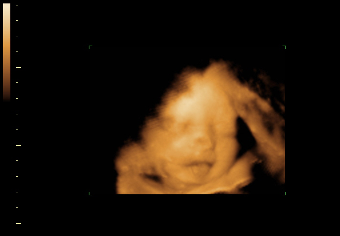 3D ultrasound image at 29 weeks